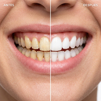 Antes y después blanqueamiento dental